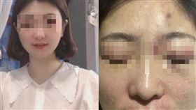  女子被滴滴公司主管強迫參加飯局，遭客戶灌醉後，醒來臉上全是傷，遭到侵犯。（圖／翻攝當事人微博）