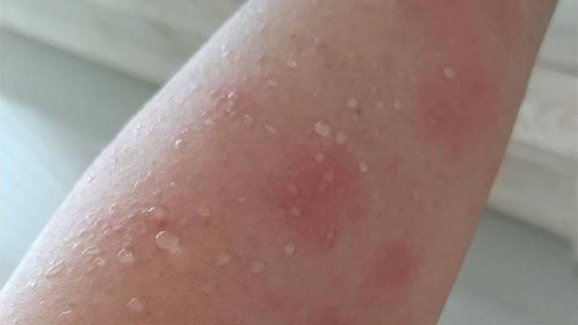 壓力大愈抓愈癢　蕁麻疹7大因子曝光