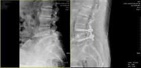 婦人右腳痠痛長達6年　一檢查才知「龍骨跑掉」（圖／亞大醫院提供）