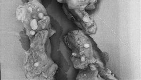 有女患者的子宮肌瘤顆數，竟如「芝麻」般多。（圖／李偉浩醫師授權提供）