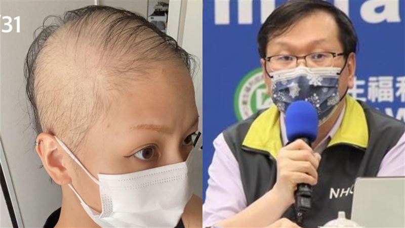 她打莫德納後變禿頭　指揮中心回應了