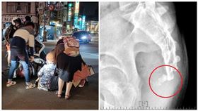 尾椎骨折(南投醫院提供)