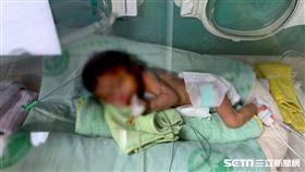 唇顎裂寶寶／羅慧夫顱顏基金會