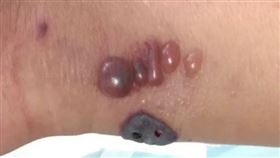 炭疽病（圖／翻攝自北京市疾控中心微信公眾號）