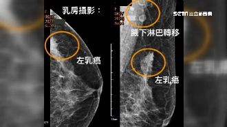 婦打莫德納腋下腫　就醫意外揪出乳癌