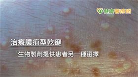 在各種乾癬類型中，膿疱型乾癬是屬於較嚴重的疾病。吳南霖主任指出，膿疱型乾癬是一種自體發炎暨免疫失衡的疾病，特徵是皮膚出現小顆膿疱，分為局部性、肢端性和全身性，局部性常見手掌、腳掌處，也可能出現在指端處。