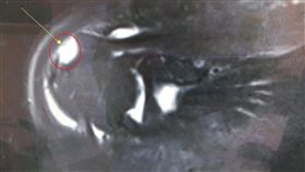 旋轉肌肌腱破裂(紅圈箭頭處)是因外傷或長期磨損退化造成，需依賴醫師經驗及核磁共振檢查來確診（圖／大千醫院提供）