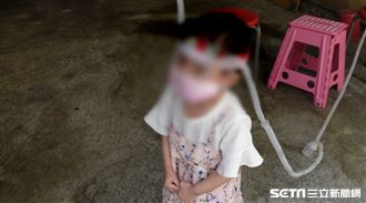 換肺才能正常呼吸　女童臉上離不開它