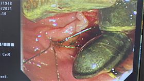 男子心臟痛以為「主動脈剝離」　竟是總膽管結石（圖／長安醫院提供）
