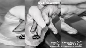 幼稚園,手指,斷指,手術,高雄,王韋力