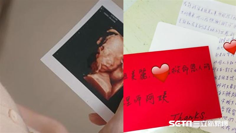 產檢出唇顎裂　護理師脫口罩：我也是
