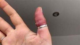 戒指亂戴睡著…女網紅姆指「腫脹發紫」　送醫拔出仍慘斷（圖／翻攝自抖音positivami）