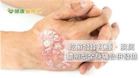 乾癬是皮膚發炎性疾病，因免疫細胞過度活化，導致表皮過度增生，脫屑、變紅、變厚。李志宏醫師說明，西方人盛行率較高，約為2-3%，東方族群較少，台灣為0.3-0.5%。