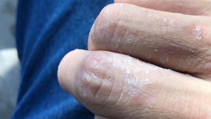 手莫名脫皮　醫卻問：你屬蛇？