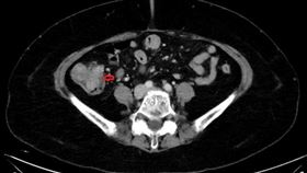 她排便習慣改變　竟發現第3期大腸癌(慈濟醫院提供)