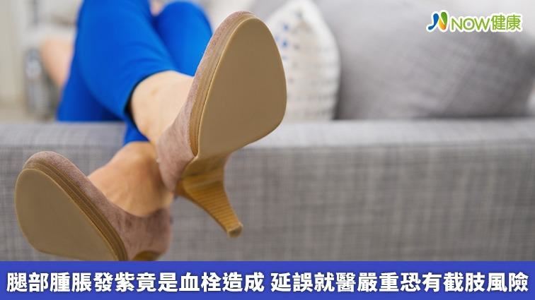 腿部腫脹發紫？　延誤就醫恐截肢　
