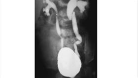 小孩如果每個月反覆發燒，父母親得特別當心！有可能是腎臟已經出現問題，萬一延遲就醫，恐怕得步上洗腎人生。（圖／中國醫藥大學兒童醫院提供）