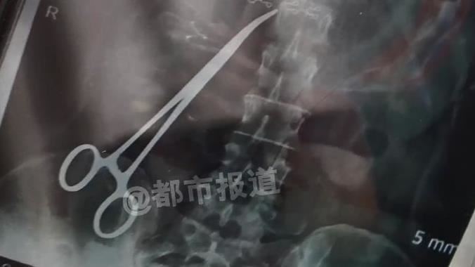 剖腹產後劇痛1年多　肚中竟藏止血鉗