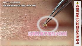 ▼▲這位客人的鼻子旁有一顆大粉刺。（圖／專業無痛清粉刺/痘痘/內皰-台北市 授權）