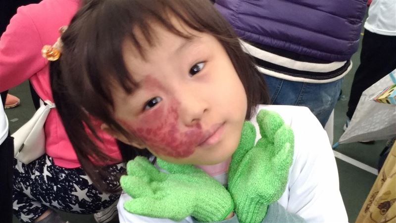 女童顏面罹患血管畸形　繪畫找回自信