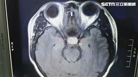 ▲ 上為患者頭部核磁共振圖像，紅圈處為腦下垂體腫瘤, 神經外科趙紹清主任（圖／衛福部彰化醫院提供）