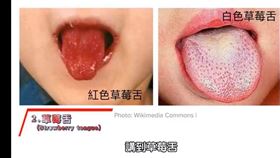 幼童，草莓舌，新冠舌頭，圖／翻攝自蔡逸姍醫師臉書