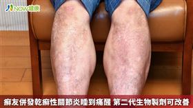 名家專用／NOW健康／使用第二代生物製劑治療後，Steven身上的皮癬獲得大幅度的改善，同時也兼顧了關節的保護。(勿用)