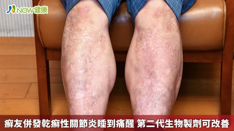 癬友併發乾癬性關節炎睡到痛醒