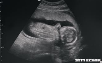 引產就是不愛？懷胎20週孕婦吐煎熬