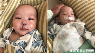 唇腭裂能好嗎？4月大嬰首次手術揭曉