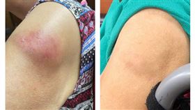 92歲陳奶奶接種新冠肺炎疫苗後疫苗副作用明顯，整個人虛弱無力，疫苗接種處也呈現大片紅腫（左）；經治療，陳奶奶恢復過往的活力，手臂也明顯消腫（右）。（圖／台北慈院提供）