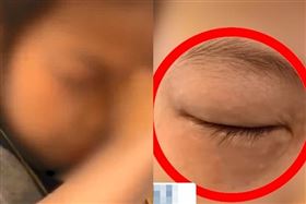 女童罹怪病！一算數學眼睛腫到像貓熊（圖／網易新聞）