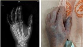 阿嬤被魚刺傷手腫險壞死　醫一看：沒即時處理會要命（圖／彰基提供）