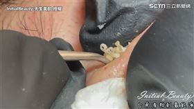▼▲該個案正處於青春期階段，皮脂腺分泌旺盛。（圖／InitialBeauty 天生美肌 授權）