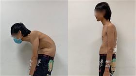 長期彎腰駝背　27歲男身高竟少了45公分（圖／台北慈院提供）