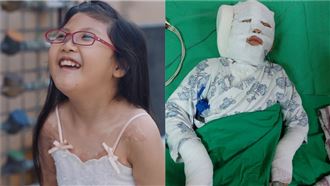 露營熱水壺爆炸　女童嚴重燒傷現況曝