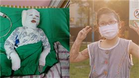 燒燙傷女童，渝兒（圖／受訪者提供）