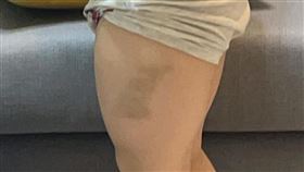 一名母親將小孩從幼稚園接回家，洗過澡後驚見孩子大腿有大片瘀青。（圖／翻攝自爆怨公社）