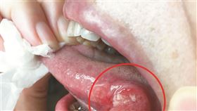 口腔痛、舌頭破卻怕疫情不敢就醫　女子拖成「舌癌」（圖／彰基提供）