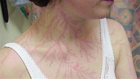 ▲被閃電「紋身」。（圖／翻攝自百度百科）