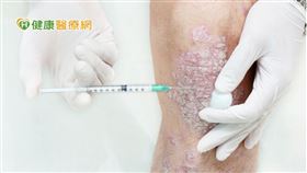 根據健保給付規範，乾癬病患經過足量照光治療，以及至少兩種系統性藥物治療各三個月後，疾病嚴重度（PASI）仍達到10分以上才符合健保申請條件，對病情嚴重患者來說緩不濟急。