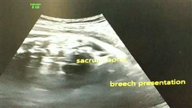 寶寶胎位不正將臨盆　護理師還硬凹神明想轉正（圖／阮綜合醫院提供）