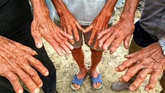 徒手挖藕變形成「老鷹手」震撼畫面曝