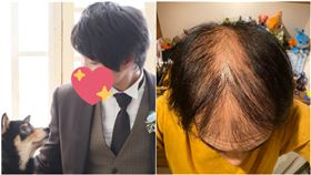 接種狂脫髮！帥哥打完疫苗變禿頭　2個月後曬對比照網嚇瘋（圖／翻攝自@irushige推特）