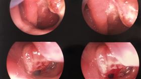 鼻塞,耳鼻喉科,鼻咽癌,腫瘤,大千綜合醫院,戒菸,黃山崧
圖／大千綜合醫院提供