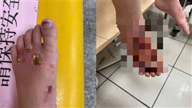  4歲男童，遭凌虐，雙腳大面積燙傷壞死，生殖器遭夾傷，怒控無照保母邱姓女子施虐，(圖／男童媽媽提供)