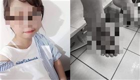 ▲彰化4歲男童遭無照惡保母邱女燙腳，傷口已化膿壞死。（圖／家屬提供）