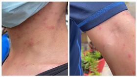 ▲澎湖出現大量民眾皮膚生奇癢紅疹的狀況，衛生局表示已經排除是傳染病。（圖／翻攝畫面）