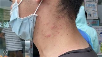 澎湖爆「奇癢怪病」莊人祥揭可能病因