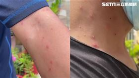 澎湖奇癢怪疹驚動CECC! 皮膚科200人擠爆求診（組圖）